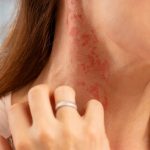 What Are the Common Causes of Skin Allergies?
