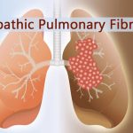 All You Need to Know About Idiopathic Pulmonary Fibrosis