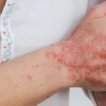 Everything About Causes, Treatment, and Symptoms of Eczema