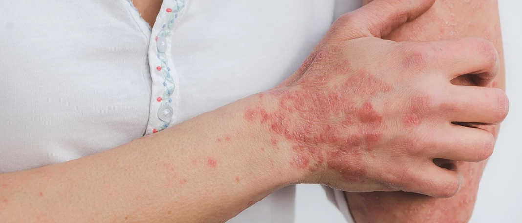 Everything About Causes, Treatment, and Symptoms of Eczema