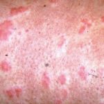 Anaphylaxis – Symptoms, Causes, Treatment and Prevention