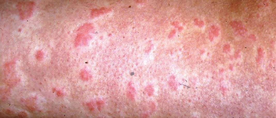 Anaphylaxis – Symptoms, Causes, Treatment and Prevention