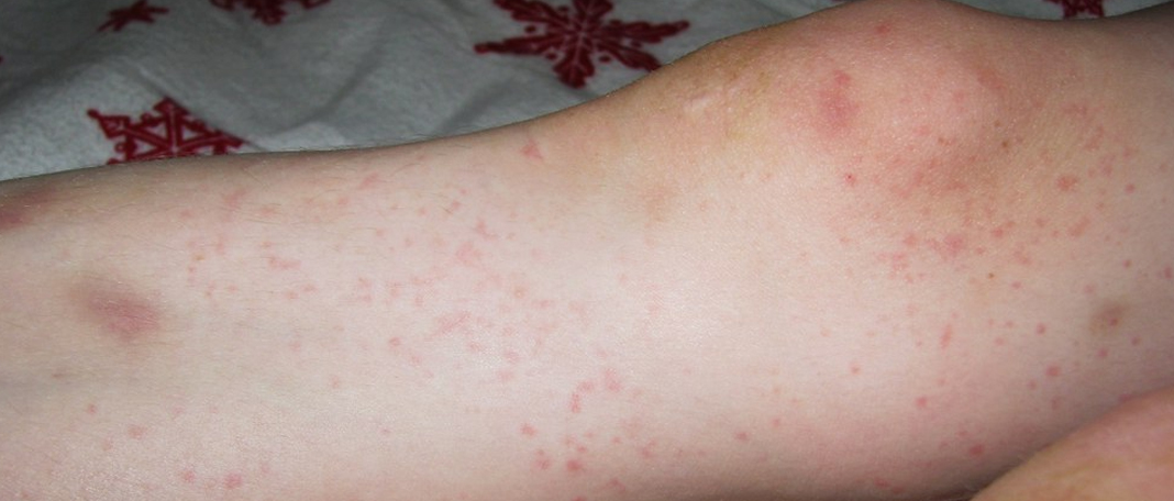 Natural Ways to Avoid Basic Allergies