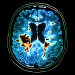What Causes Multiple Sclerosis?