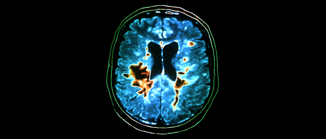 What Causes Multiple Sclerosis?