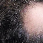 Alopecia Areata: Causes, Symptoms and Treatment