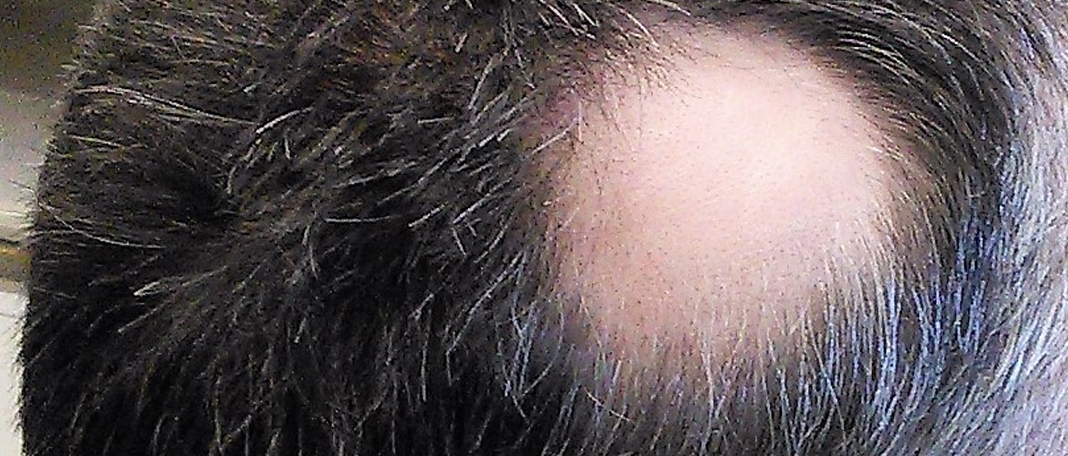 Alopecia Areata: Causes, Symptoms and Treatment