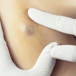 Causes and Symptoms of Skin Lumps