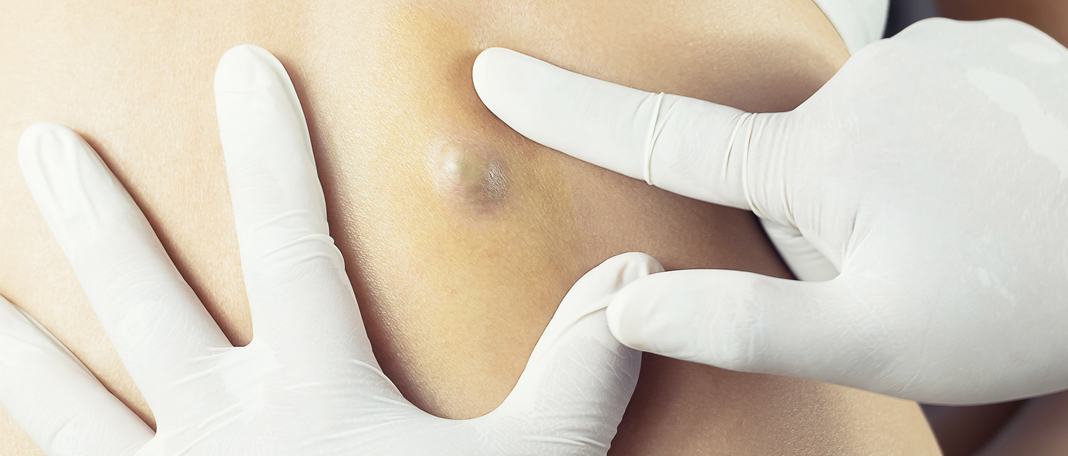 Causes and Symptoms of Skin Lumps