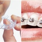 What works Better – Aligners or Braces?