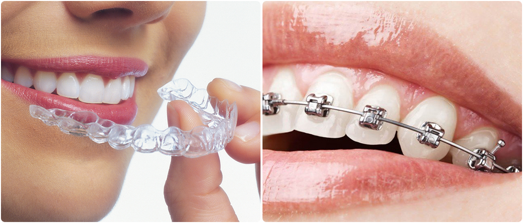 What works Better – Aligners or Braces?