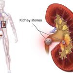 Kidney Stones