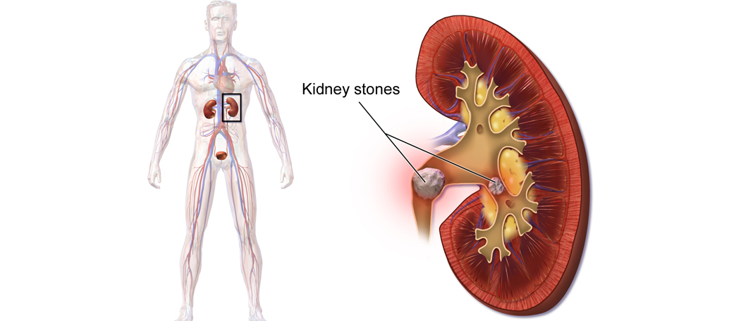 Kidney Stones
