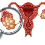 Is There a Vaccine for Ovarian Cancer?