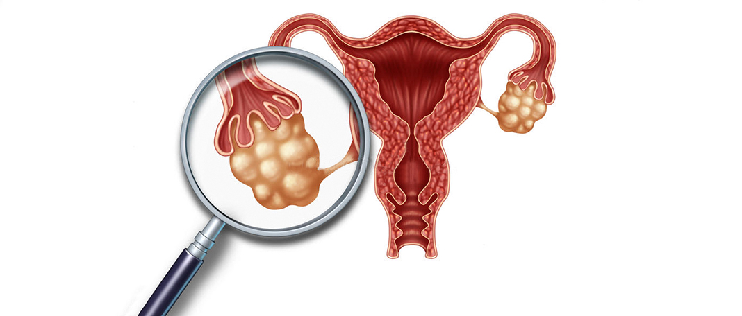 Is There a Vaccine for Ovarian Cancer?