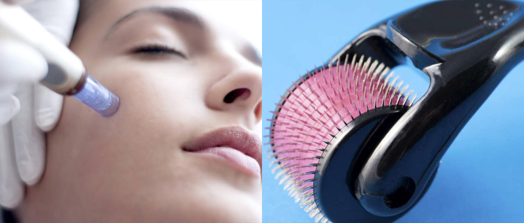 Things to Know About Microneedling
