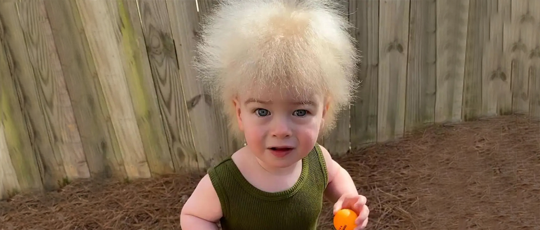Gene Mutations can Cause your Hair Frizzy and Uncombable