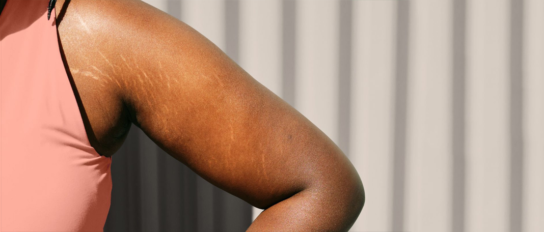 Stretch Marks on Breasts: Reason, Reduction and Prevention