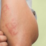 All You Need To Know About Scabies