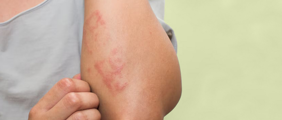 All You Need To Know About Scabies