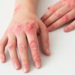 Lupus: Types, Symptoms, Treatment, and More