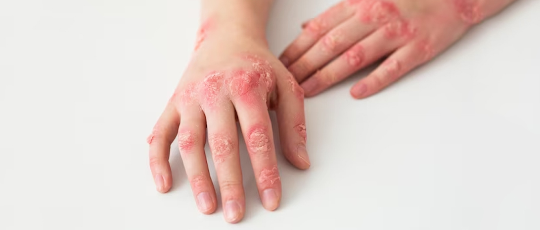Lupus: Types, Symptoms, Treatment, and More