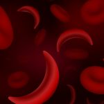 Sickle Cell Disease: Symptoms, Causes, Treatment, and Prevention
