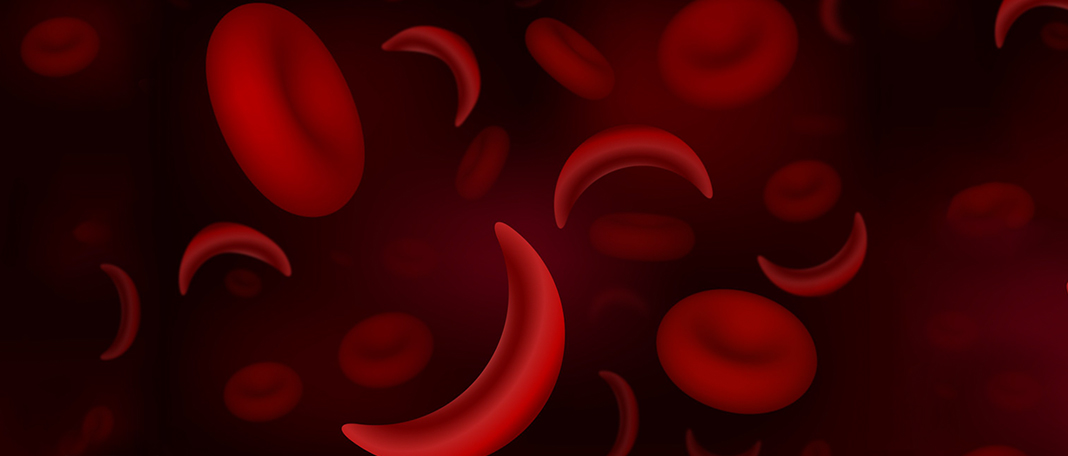 Sickle Cell Disease: Symptoms, Causes, Treatment, and Prevention