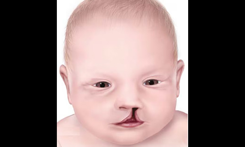 Clefts