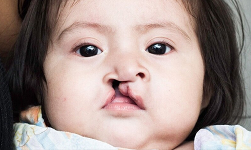 Types of Cleft Lip