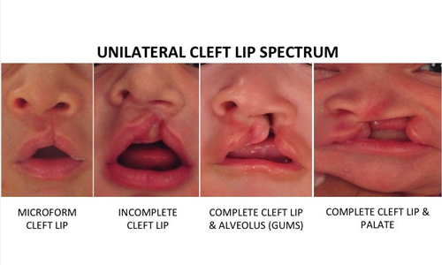 Unilateral Cleft Lip