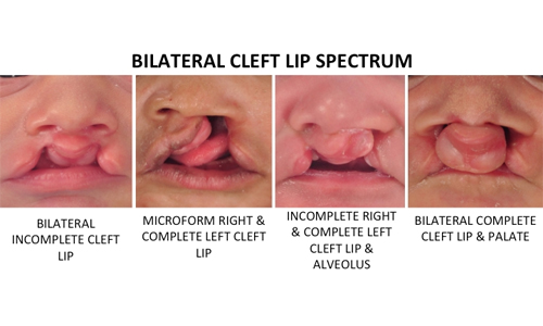 Bilateral Cleft Lip