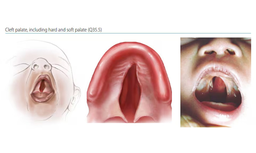 Complete Cleft Palate