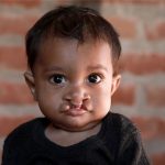 What Are the Different Types of Clefts?