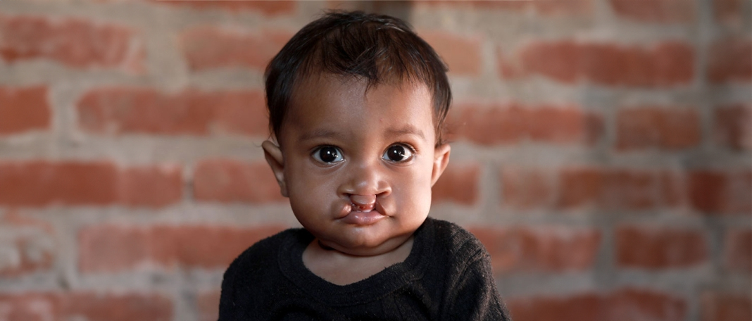What Are the Different Types of Clefts?