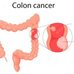 How to Lower the Risk of Colon Cancer?