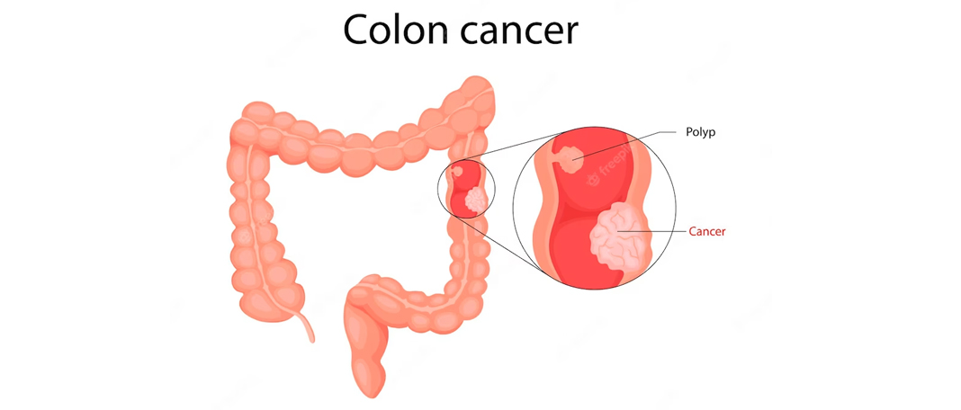 How to Lower the Risk of Colon Cancer?