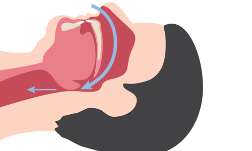 Sleep-Apnea
