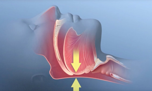 Obstructive-Sleep-Apnea