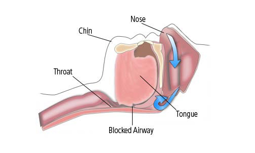 Complex-Sleep-Apnea