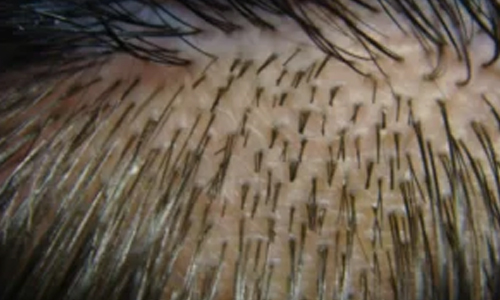 Origin-of-Hair-Transplants