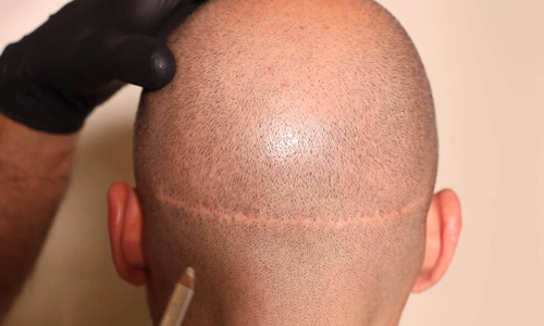 Follicular-Unit-Transplantation
