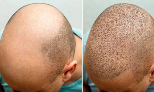 Follicular-Unit-Extraction