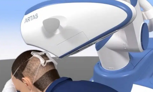 ARTAS-Robotic-Hair-Transplants