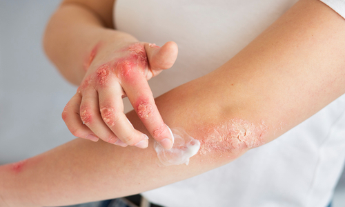 How to Treat Fungal Infection?