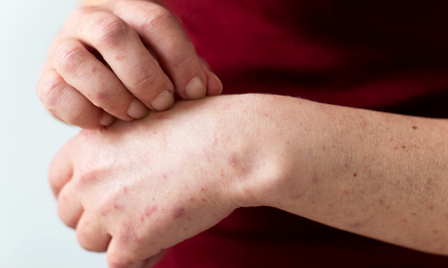 What is a Fungal Infection?