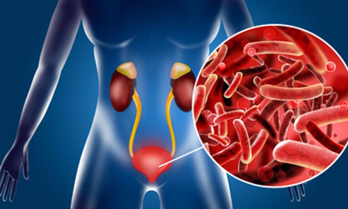 Urinary-Tract-Infections