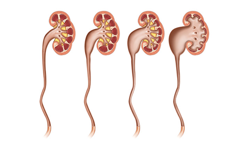 Hydronephrosis