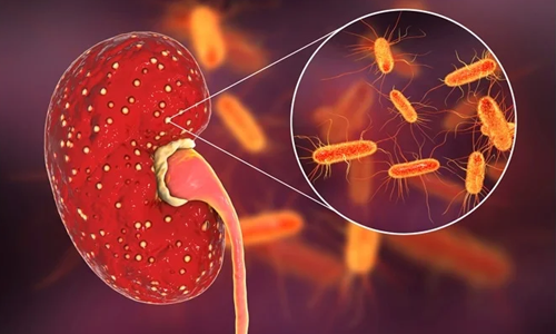Pyelonephritis