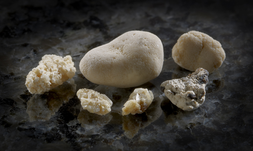 Understanding-Kidney-Stones